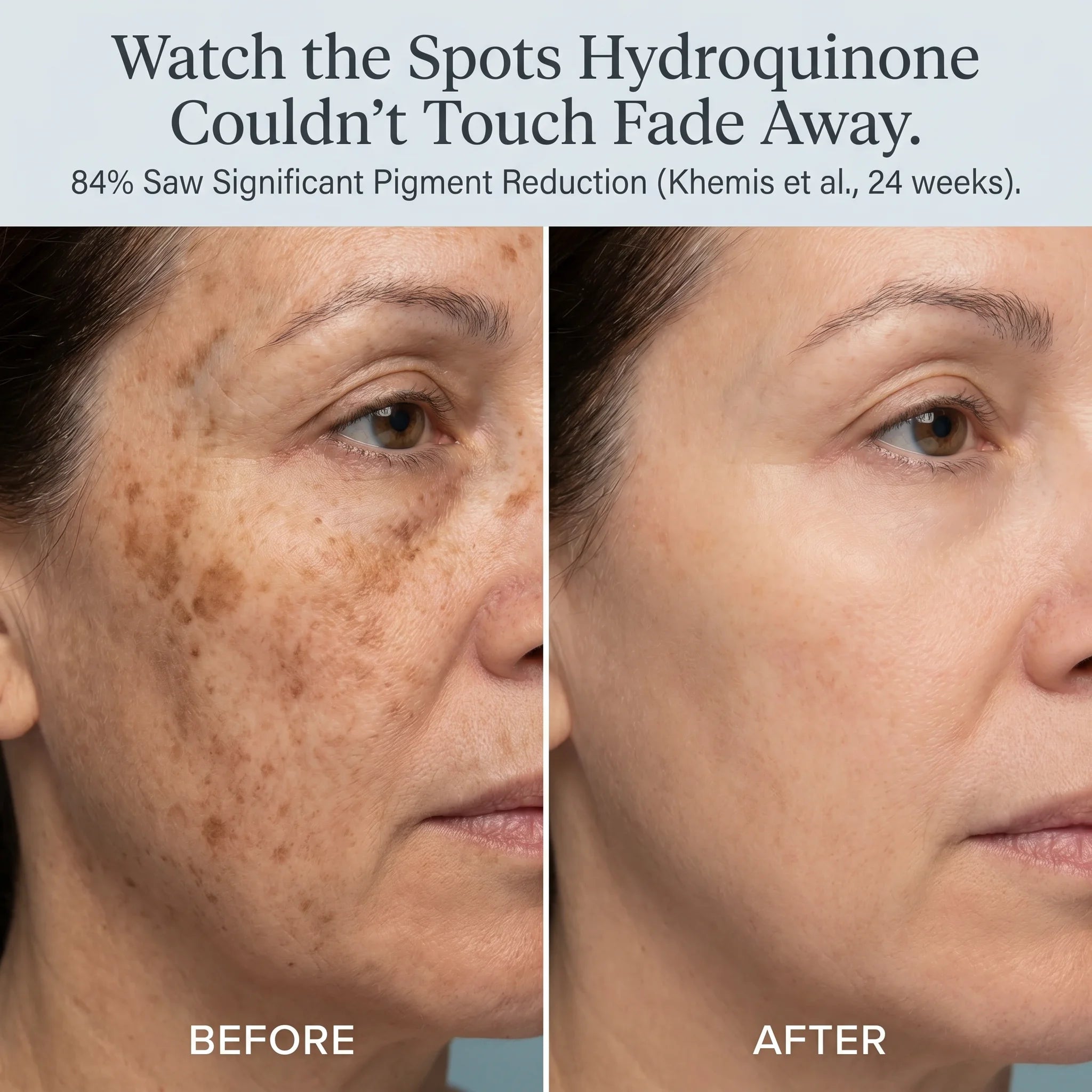 Cheek and jaw before/after — 84% saw significant pigment reduction (Khemis et al., 24 weeks)