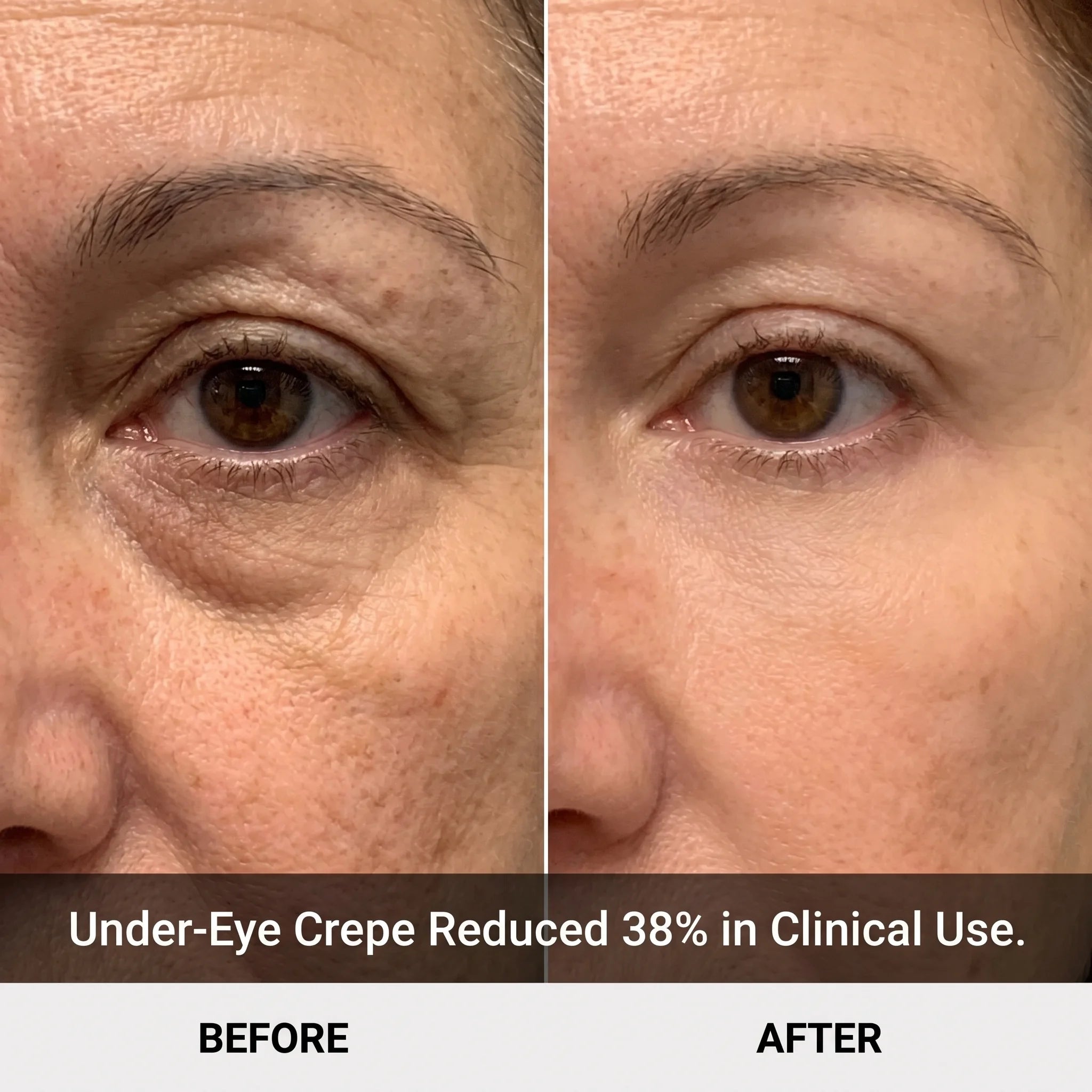 Close-up before/after — under-eye fold softens, flinch reflex stops